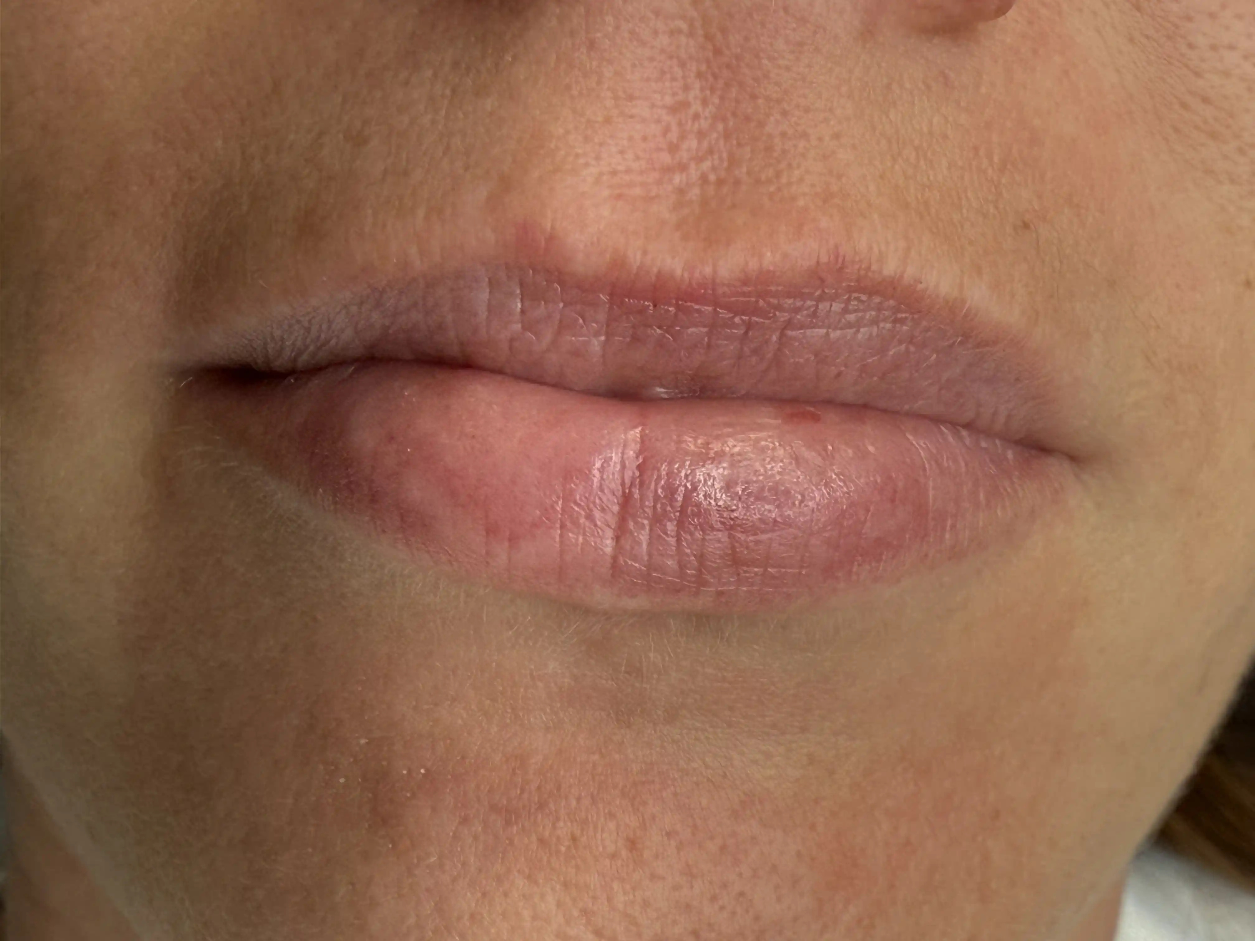 Vorher – Sensual Lips